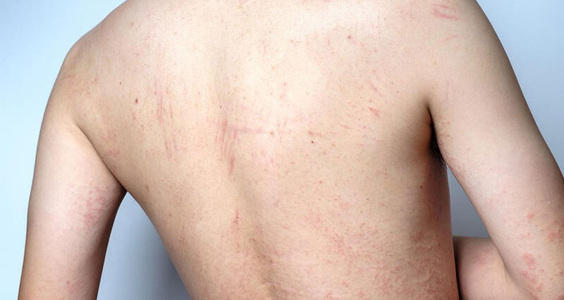 Viêm da do côn trùng cắn dấu hiệu và cách xử lý tại nhà