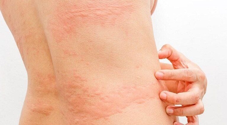 Côn trùng dị ứng tại sao bạn luôn ngứa ngáy khó chịu?